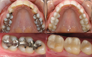 SR 300x187 Trám và phục hồi răng ở nha khoa Quốc tế Á Châu