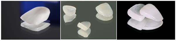 Mặt dán sứ dental lumineers siêu mỏng thẩm mỹ ở nha khoa quốc tế Á Châu