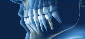 Răng sứ Cercon trên implant