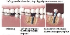 Cau-truc-cua-Implant-Nha-khoa-40