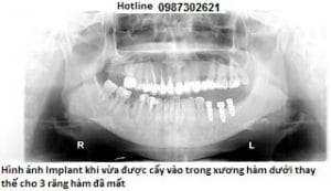 Cau-truc-cua-Implant-Nha-khoa-9