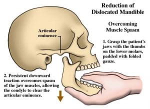 Nan-trat-khop-TD-H-3