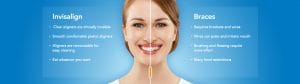 invisalign