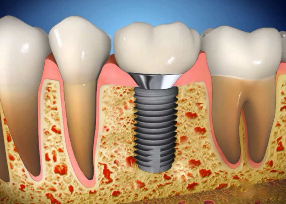 Dental-Implants-top-5
