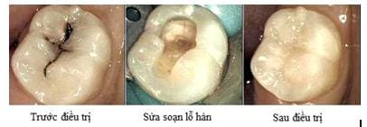 hàn răng sâu hàn răng sâu
