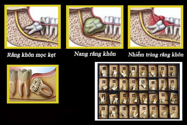 Nhổ răng khôn không đau