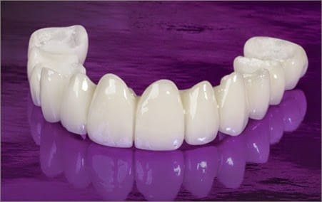 Bọc răng sứ tốn hết bao nhiêu tiền 