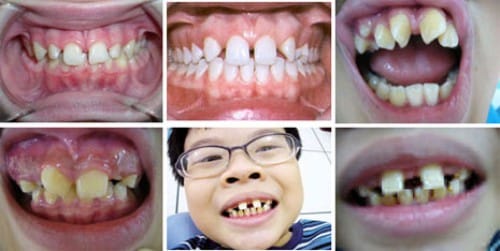 nhận biết răng bé bị thưa từ sớm