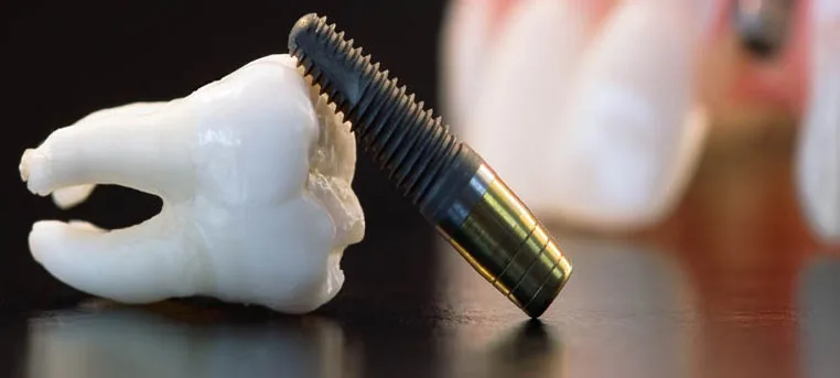 cắm implant ở đâu tốt