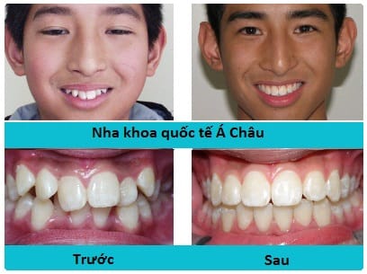 Hình ảnh trước và sau khi niềng răng 