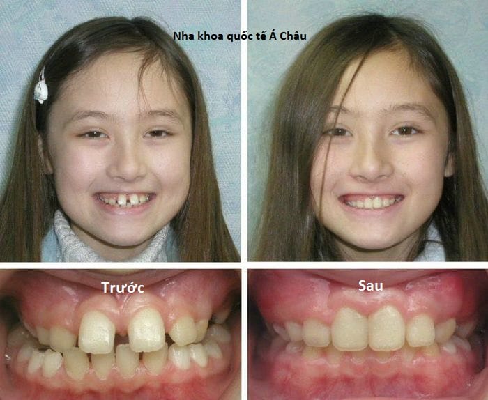 nieng-rang-mang-tang-hinh