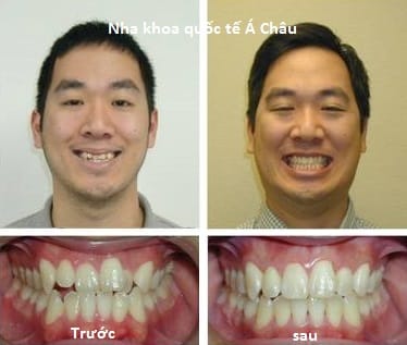 nieng-rang-tang-hinh-do-nhe