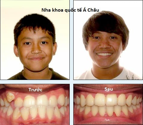 nieng-rang-tra-gop-vd