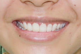 phẫu thuật nướu làm dài thân răng