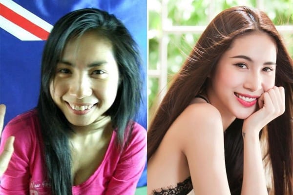 sự khác biệt trước và sau niềng răng