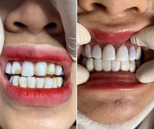 Hậu quả răng nứt vỡ Hậu quả răng nứt vỡ